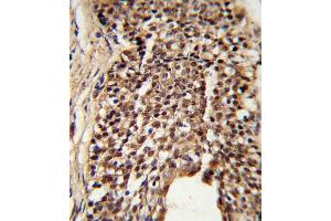 Formalin-fixed and paraffin-embedded human prostate carcinoma reacted with TPI1 Antibody (N-term), which was peroxidase-conjugated to the secondary antibody, followed by DAB staining. (TPI1 antibody  (N-Term))