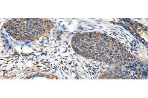Immunohistochemistry of paraffin-embedded Human cervical cancer tissue using BRI3BP Polyclonal Antibody at dilution of 1:35(x200) (BRI3BP antibody)