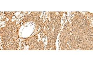 Immunohistochemistry of paraffin-embedded Human esophagus cancer tissue using TIPRL Polyclonal Antibody at dilution of 1:60(x200) (TIPRL antibody)