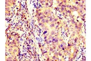 IHC image of ABIN7175618 diluted at 1:200 and staining in paraffin-embedded human pancreatic cancer performed on a Leica BondTM system. (KCNAB1 antibody  (AA 287-401))