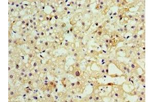 Immunohistochemistry of paraffin-embedded human liver cancer using ABIN7160457 at dilution of 1:100 (MOG antibody  (AA 30-154))