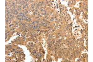 The image on the left is immunohistochemistry of paraffin-embedded Human ovarian cancer tissue using ABIN7130780(PTPRE Antibody) at dilution 1/10, on the right is treated with fusion protein. (PTPRE antibody)