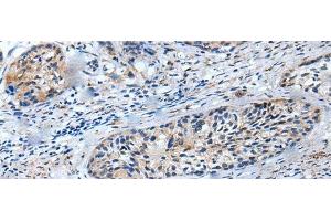 Immunohistochemistry of paraffin-embedded Human cervical cancer tissue using LILRB5 Polyclonal Antibody at dilution of 1:25(x200) (LILRB5 antibody)