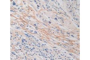IHC-P analysis of Human Stomach Cancer Tissue, with DAB staining. (Periostin antibody  (AA 97-230))