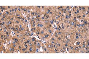 Immunohistochemistry of paraffin-embedded Human liver cancer tissue using ADM2 Polyclonal Antibody at dilution 1:40 (Adrenomedullin 2 antibody)