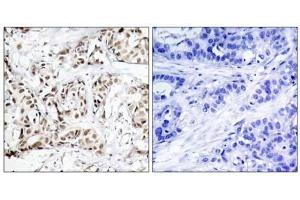 Immunohistochemical analysis of paraffin-embedded human breast carcinoma tissue using SAPK/JNK (phospho-Thr183) antibody (E011249). (SAPK, JNK (pThr183) antibody)