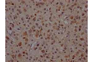 IHC image of ABIN7127867 diluted at 1:100 and staining in paraffin-embedded human glioma cancer performed on a Leica BondTM system. (Recombinant VCP antibody)