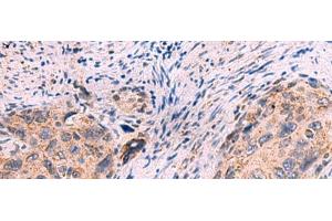 Immunohistochemistry of paraffin-embedded Human cervical cancer tissue using KCNN1 Polyclonal Antibody at dilution of 1:55(x200) (KCNN1 antibody)