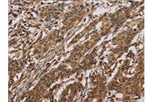 The image on the left is immunohistochemistry of paraffin-embedded Human gastric cancer tissue using ABIN7190293(CLEC2A Antibody) at dilution 1/20, on the right is treated with synthetic peptide. (CLEC2A antibody)