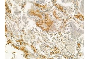 ABIN6266038 and ABIN6278294 at 1/100 staining human lung squamous cell carcinoma by IHC-P.