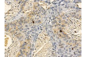 Lyl1 Mouse Monoclonal Antibody at 1/100 staining human lung cancer and adjacent non-tumor tissue by IHC-P.
