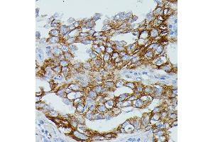 Immunohistochemistry of paraffin-embedded human lung cancer using FCGR1B antibody (ABIN7267161) at dilution of 1:100 (40x lens).