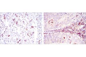 Immunohistochemical analysis of paraffin-embedded cervical cancer tissues (left) and colon cancer tissues (right) using CD1A mouse mAb with DAB staining.
