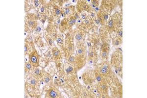 Immunohistochemistry of paraffin-embedded human liver injury using RPN1 antibody (ABIN5974065) at dilution of 1/100 (40x lens). (RPN1 antibody)