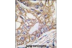 Formalin-fixed and paraffin-embedded human lung carcinoma tissue reacted with Ihh Antibody (N-term) (ABIN389152 and ABIN2850533) , which was peroxidase-conjugated to the secondary antibody, followed by DAB staining.