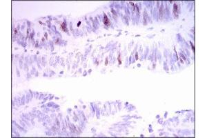 Immunohistochemical analysis of paraffin-embedded rectum cancer tissues using INCENP mouse mAb with DAB staining. (INCENP antibody  (AA 369-583))
