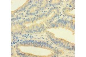 Immunohistochemistry of paraffin-embedded human endometrial cancer using ABIN7148691 at dilution of 1:100 (Crossover junction endonuclease EME1 (EME1) (AA 1-583) antibody)