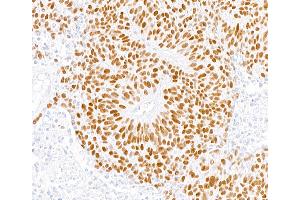 Immunohistochemistry (IHC) image for anti-MutS Homolog 6 (E. Coli) (MSH6) (AA 1310-1360) antibody (ABIN7453979) (Recombinant MSH6 antibody  (AA 1310-1360))