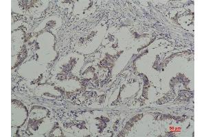 Immunohistochemical analysis of paraffin-embedded Human Breast Caricnoma using Phosphotyrosine Mouse mAb diluted at 1:200. (Phosphotyrosine antibody)