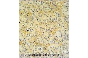 DAZ Antibody (C-term) (ABIN653931 and ABIN2843163) IHC analysis in formalin fixed and paraffin embedded prostate carcinoma followed by peroxidase conjugation of the secondary antibody and DAB staining. (DAZAP2 antibody  (C-Term))