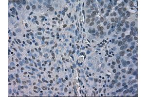 Immunohistochemical staining of paraffin-embedded Adenocarcinoma of breast tissue using anti-BUB1B mouse monoclonal antibody. (BUB1B antibody)