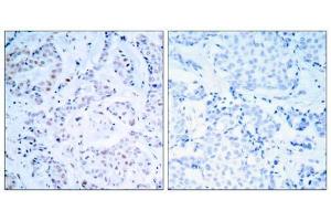 Immunohistochemical analysis of paraffin-embedded human breast carcinoma tissue using Estrogen Receptor-α (Ab-104) antibody (E021065). (Estrogen Receptor alpha antibody)