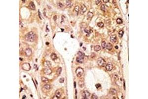 IHC analysis of FFPE human hepatocarcinoma tissue stained with the TLR5 antibody (TLR5 antibody  (AA 825-856))