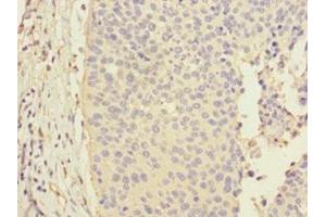 Immunohistochemistry of paraffin-embedded human cervical cancer using ABIN7146495 at dilution of 1:100