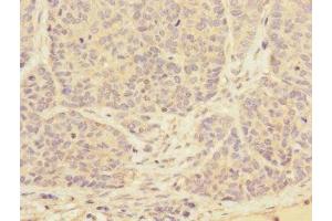 Immunohistochemistry of paraffin-embedded human ovarian cancer using ABIN7173562 at dilution of 1:100 (Tropomyosin 4 antibody  (AA 1-248))