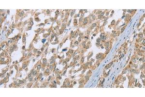 Immunohistochemistry of paraffin-embedded Human esophagus cancer using ECHS1 Polyclonal Antibody at dilution of 1:35