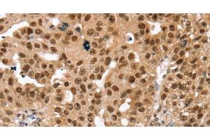 Immunohistochemistry of paraffin-embedded Human breast cancer using SMARCB1 Polyclonal Antibody at dilution of 1:30 (SMARCB1 antibody)