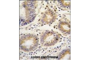 Formalin-fixed and paraffin-embedded human colon carcinoma tissue reacted with LEFTB antibody (C-term)  , which was peroxidase-conjugated to the secondary antibody, followed by DAB staining. (LEFTY1 antibody  (C-Term))