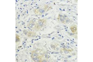 Immunohistochemistry of paraffin-embedded human liver cancer using SURF4 antibody (ABIN7270650) at dilution of 1:200 (40x lens). (Surfeit 4 antibody  (AA 50-150))