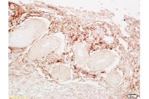 Formalin-fixed and paraffin embedded human lung carcinoma labeled with Anti-LDL Polyclonal Antibody, Unconjugated (ABIN678548) at 1:200, followed by conjugation to the secondary antibody and DAB staining (LDL antibody)