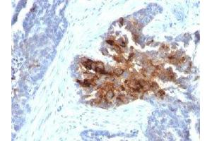 IHC staining of human ovarian carcinoma with TAG-72 antibody cocktail (B72. (TAG-72 antibody)