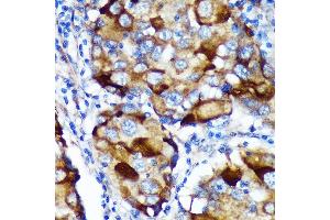 Immunohistochemistry of paraffin-embedded Human breast cancer using  Rabbit pAb (ABIN7265743) at dilution of 1:100 (40x lens). (ABCF3 antibody  (AA 1-200))