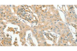 Immunohistochemistry of paraffin-embedded Human lung cancer using ACE1 Polyclonal Antibody at dilution of 1:70 (Angiotensin I Converting Enzyme 1 antibody)