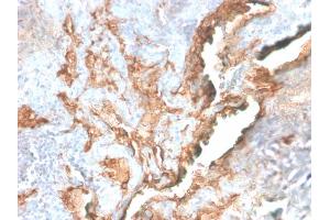 Formalin-fixed, paraffin-embedded human Lung Carcinoma stained with Tenascin C Rabbit Recombinant Monoclonal Antibody (TNC/2981R). (Recombinant TNC antibody)