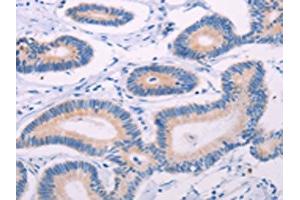 The image on the left is immunohistochemistry of paraffin-embedded Human colon cancer tissue using ABIN7131322(TEKT4 Antibody) at dilution 1/20, on the right is treated with fusion protein. (Tektin 4 antibody)