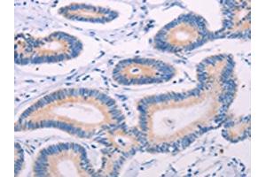 The image on the left is immunohistochemistry of paraffin-embedded Human colon cancer tissue using ABIN7131322(TEKT4 Antibody) at dilution 1/20, on the right is treated with fusion protein.