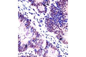(ABIN6242416 and ABIN6578503) staining KHDRBS1 in human colorectal carcinoma tissue sections by Immunohistochemistry (IHC-P - paraformaldehyde-fixed, paraffin-embedded sections). (KHDRBS1 antibody  (AA 259-291))