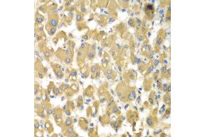 Immunohistochemistry of paraffin-embedded human liver injury using MAP4K3 antibody at dilution of 1:100 (x400 lens).
