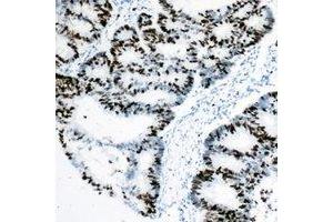 Immunohistochemical analysis of Rpb1 CTD staining in human colon cancer formalin fixed paraffin embedded tissue section. (Rpb1 CTD antibody  (C-Term))