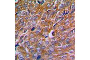 Immunohistochemical analysis of Calnexin (pS583) staining in human breast cancer formalin fixed paraffin embedded tissue section. (Calnexin antibody  (C-Term, pSer583))