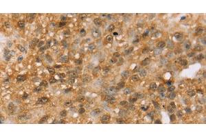 Immunohistochemistry of paraffin-embedded Human breast cancer tissue using MED22 Polyclonal Antibody at dilution 1:50 (MED22 antibody)