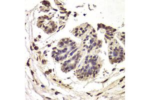 Immunohistochemistry of paraffin-embedded human breast cancer using INTS6 Antibody (ABIN5973991) at dilution of 1/100 (40x lens).