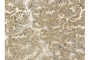ABIN6266124 and ABIN6272493 at 1/100 staining human renal cell carcinoma by IHC-P. (ZNF295 antibody  (N-Term))