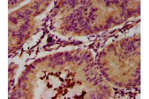 IHC image of ABIN7151818 diluted at 1:300 and staining in paraffin-embedded human endometrial cancer performed on a Leica BondTM system. (EPX antibody  (AA 140-300))