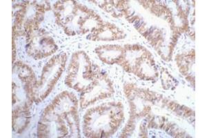 IHC-P staining of Human colon cancer tissue paraffin-embedded, diluted at 1:200. (p53 antibody)