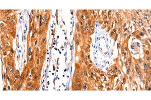 Immunohistochemistry of paraffin-embedded Human esophagus cancer tissue using FBLN1 Polyclonal Antibody at dilution 1:47 (Fibulin 1 antibody)